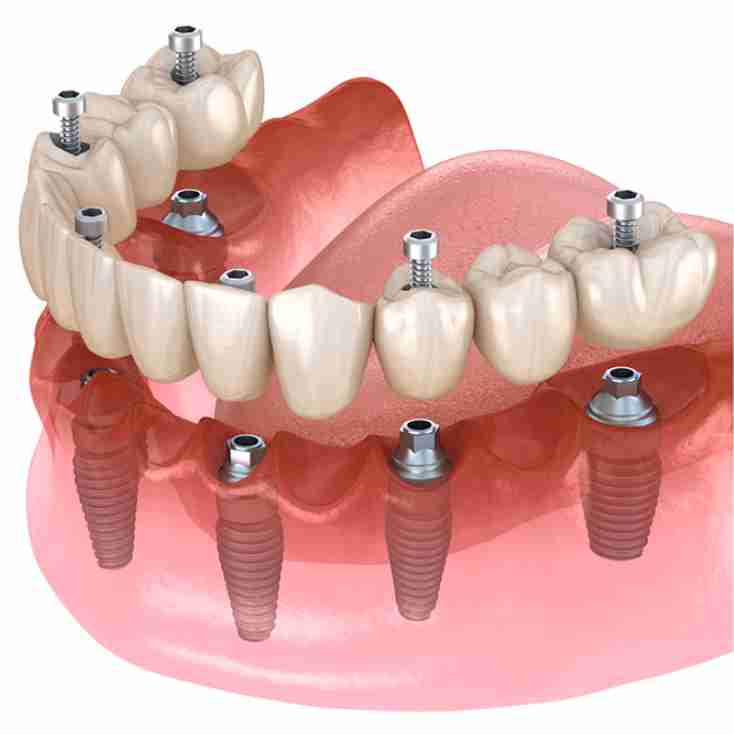 Dra. Lucía Laborde - Implantes dentales