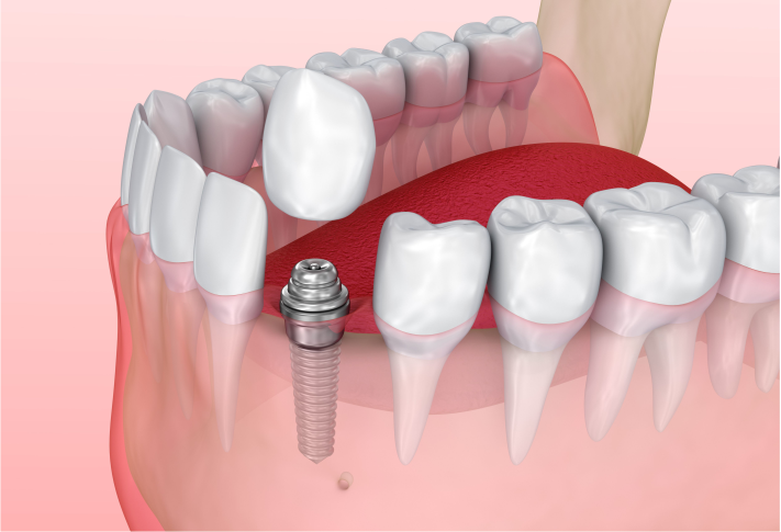 Dra. Lucía Laborde - Implantes dentales - Colocación del implante