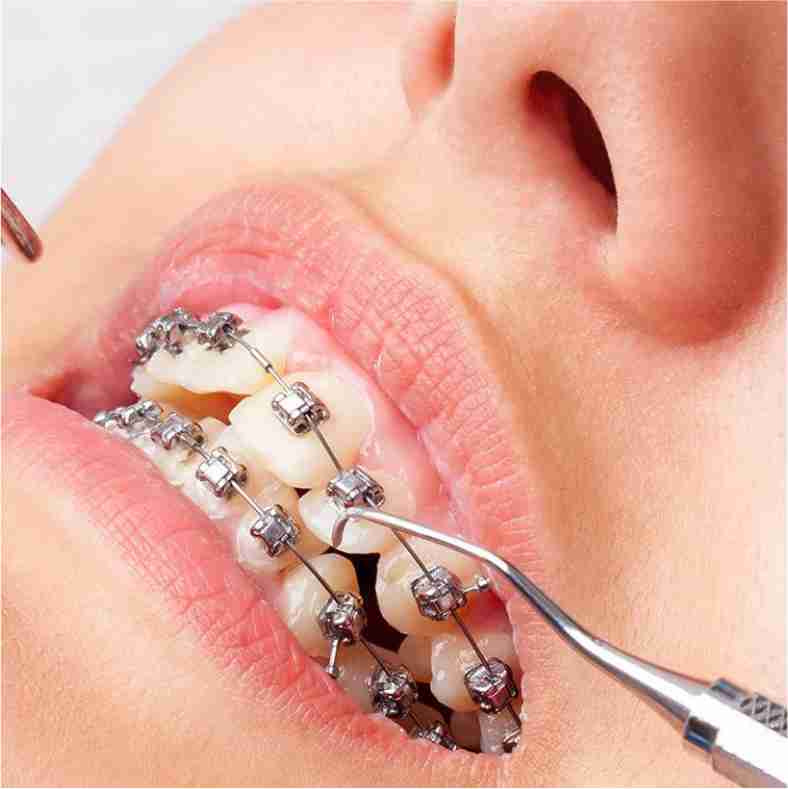 Dra. Lucía Laborde - Ortodoncia - Colocación de los aparatos de ortodoncia