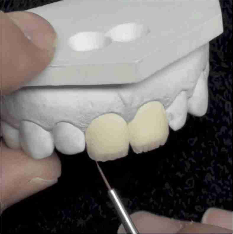 Dra. Lucía Laborde - Carillas dentales - Fabricación de las carillas