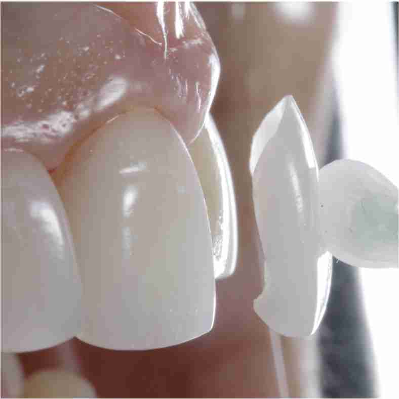 Dra. Lucía Laborde - Carillas dentales - Colocación de las carillas