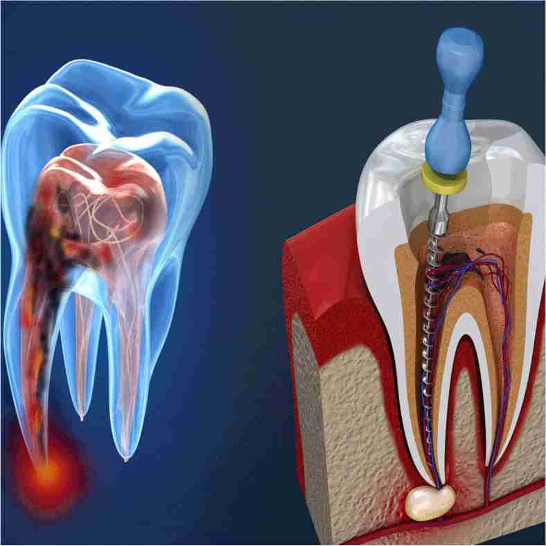 Dra. Lucía Laborde - Endodoncia - Remoción de la pulpa
