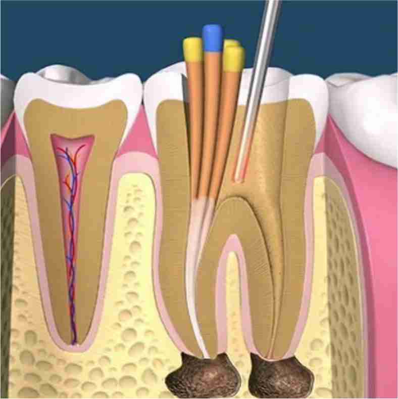 Dra. Lucía Laborde - Endodoncia - Obturación del conducto radicular