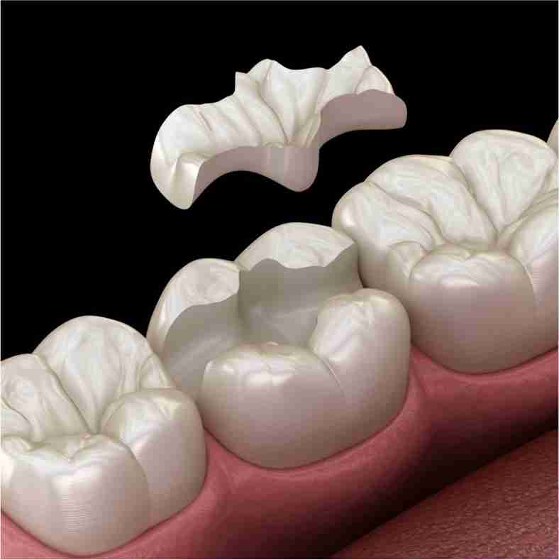 Dra. Lucía Laborde - Endodoncia - Restauración dental