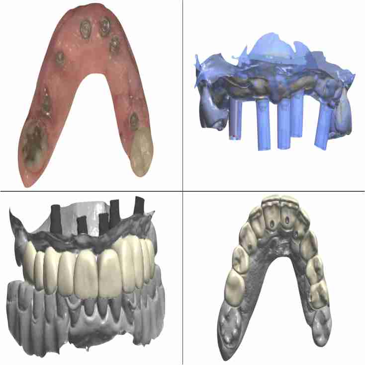 Dra. Lucía Laborde - Implantes dentales - Evaluación y planificación