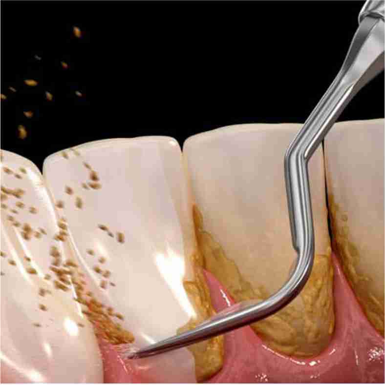 Dra. Lucía Laborde - Periodoncia - Limpieza dental profunda