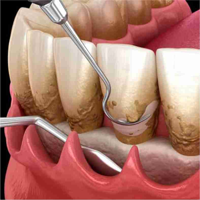 Dra. Lucía Laborde - Periodoncia - Cirugía periodontal