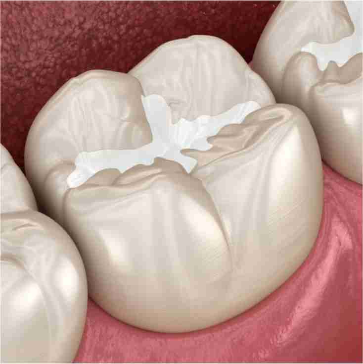 Dra. Lucía Laborde - Prevencion -	Selladores dentales