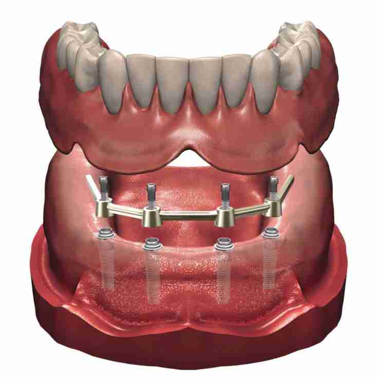 Dra. Lucía Laborde - Protesis dental - Prótesis dentales implantosoportadas