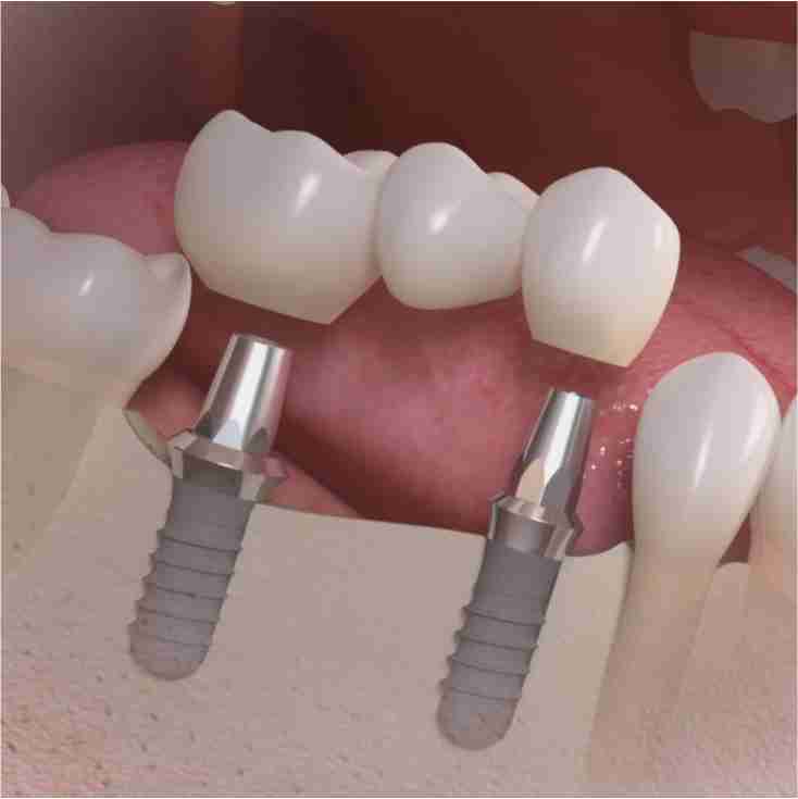 Dra. Lucía Laborde - Protesis dental - Prótesis dentales parciales